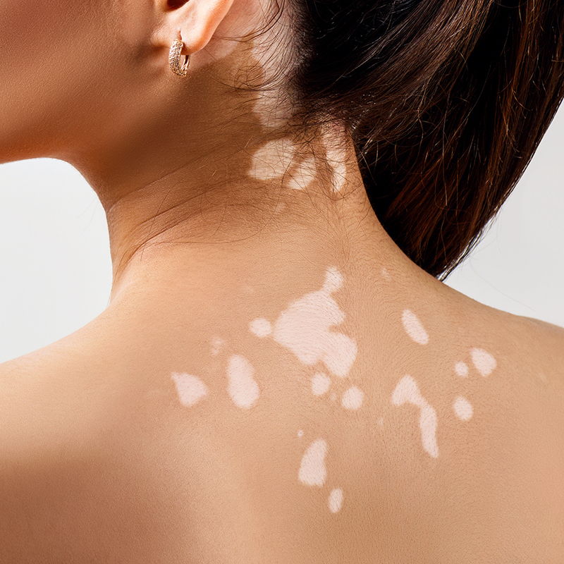 baltme vitiligo odos liga
