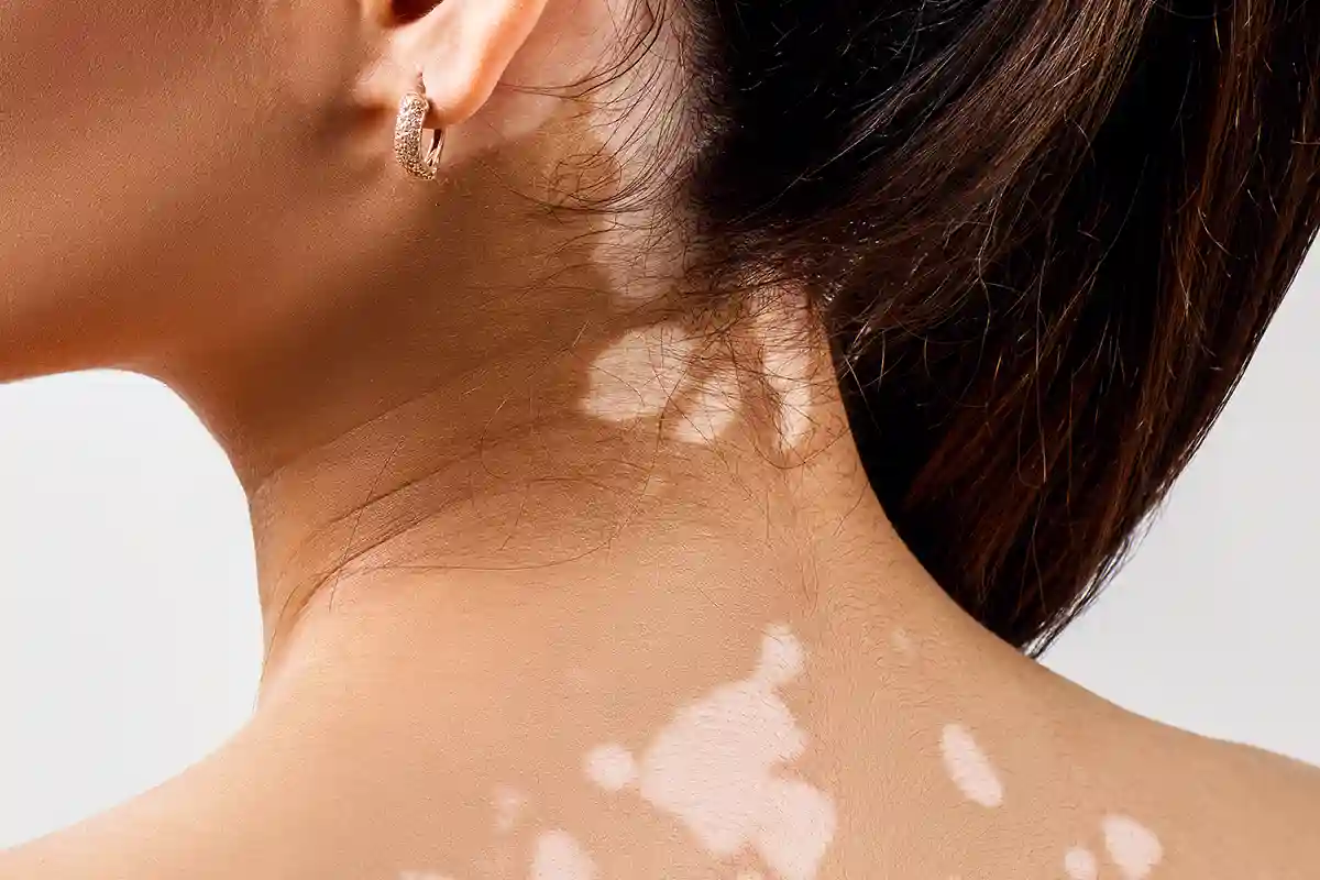 Baltmė (vitiligo)