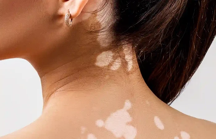 Baltmė (vitiligo)